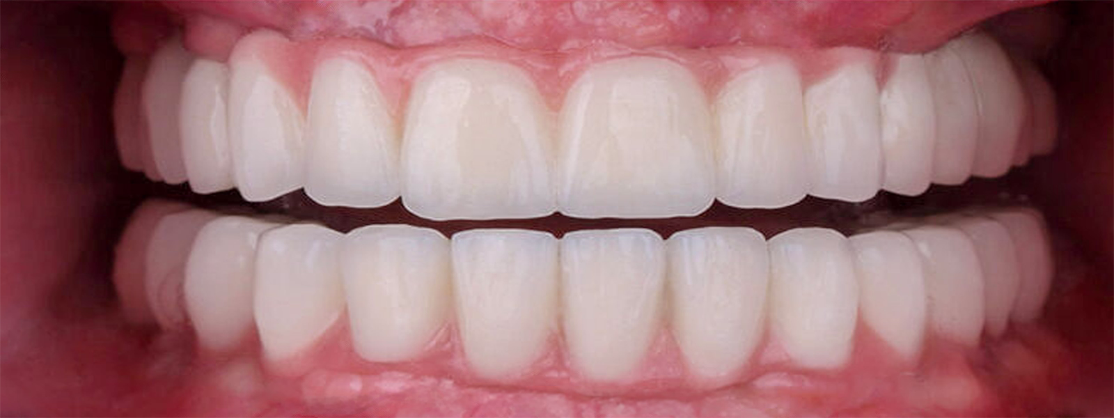 Patient smile after full-mouth dental implant restoration at ARC Dental