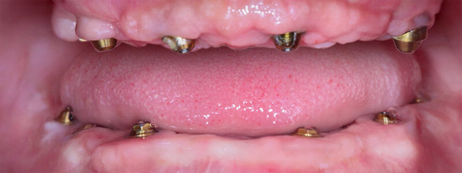Patient smile before dental implant treatment — missing and damaged teeth